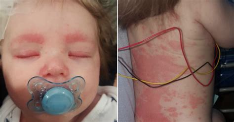 meningitis rash baby pictures